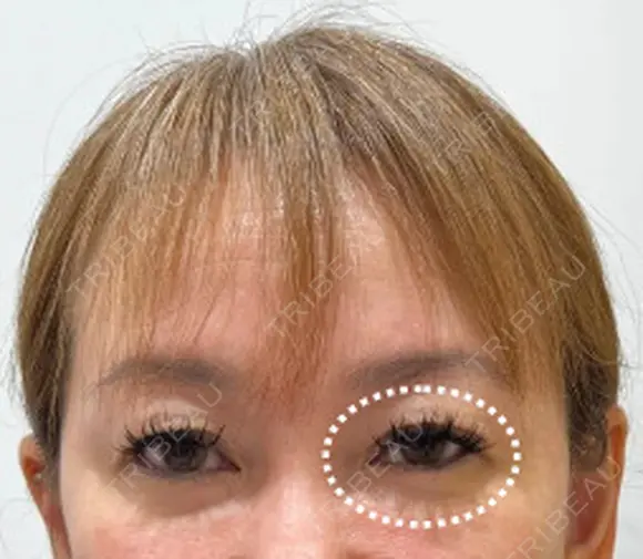 眉下リフト before画像 メイン用