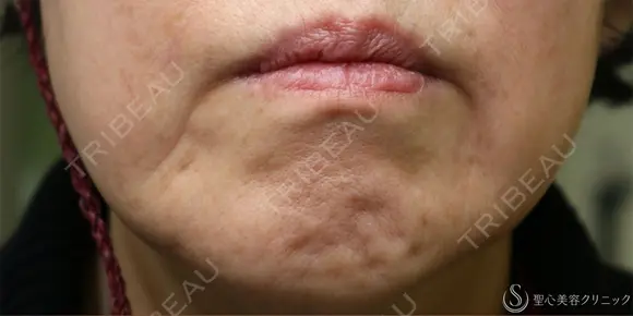 【70代女性・左マリオネットラインの長期経過】プレミアムPRP皮膚再生療法（6年後） before画像 メイン用