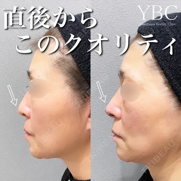 【直後からこのクオリティ鼻整形👃✨】 before画像 メイン用