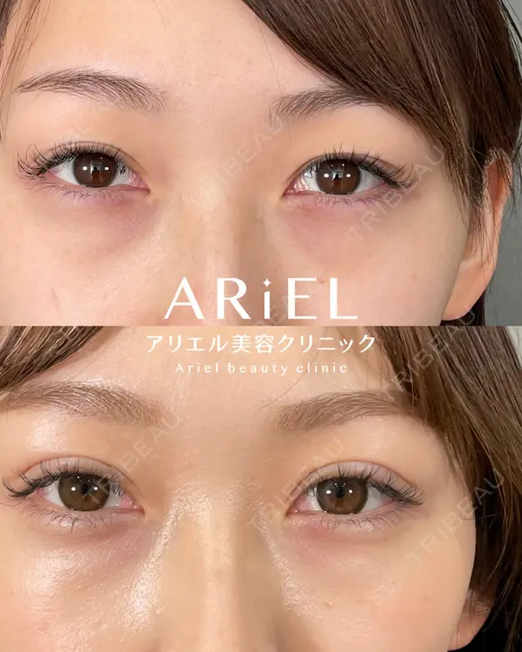 アリエルクイックループ（二重埋没法） before画像 メイン用