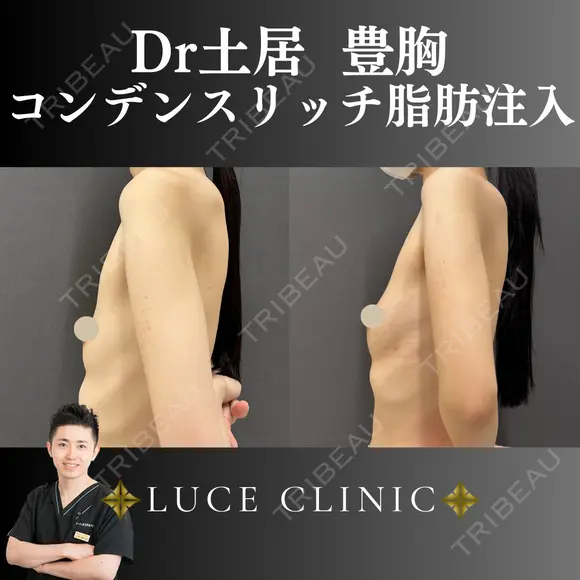 コンデンスリッチ脂肪豊胸 after画像 メイン用