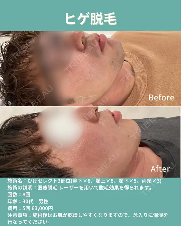 ヒゲ脱毛 before画像 メイン用