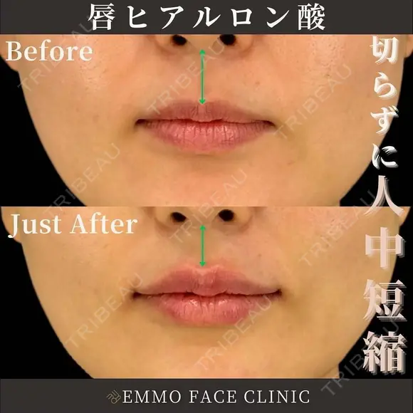 ヒアルロン酸（唇） before画像 メイン用