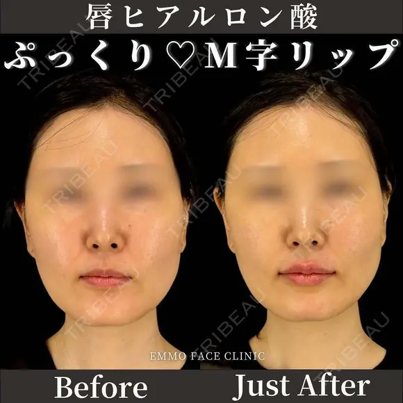 ヒアルロン酸（唇） 0日後 メイン用