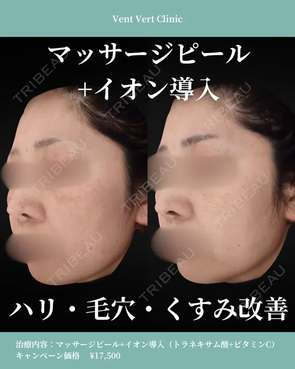 マッサージピール＋イオン導入(トラネキサム酸＋ビタミンC） before画像 メイン用