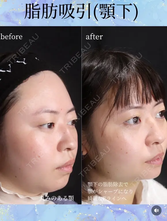 脂肪吸引（顎下） after画像 メイン用