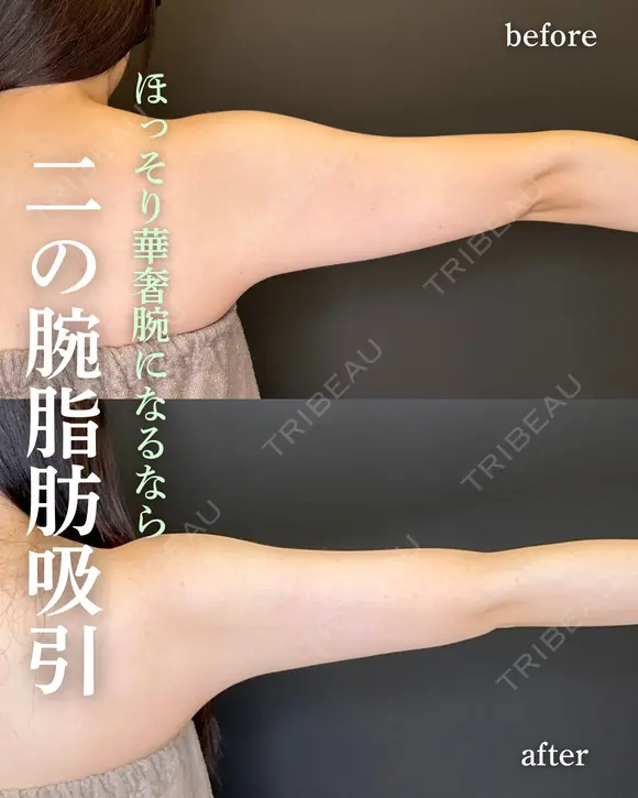二の腕+肩脂肪吸引 before画像 メイン用