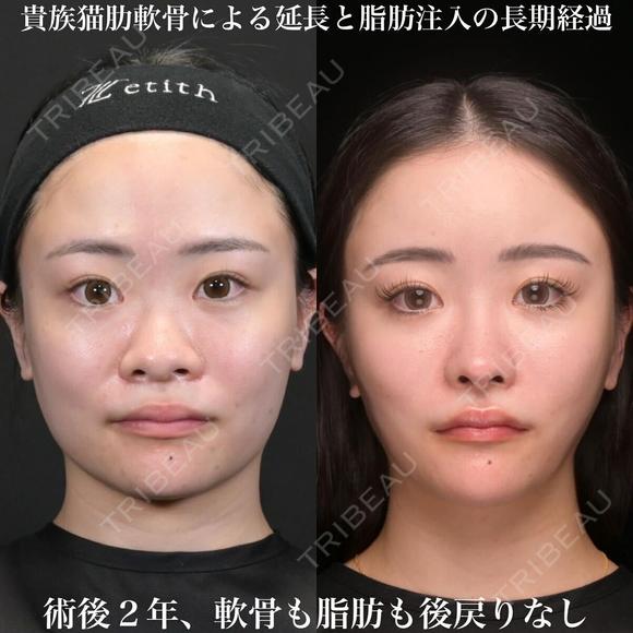 術後2年 北村医師とコラボオペ 貴族猫手術、肋軟骨による鼻中隔延長、耳介軟骨移植、鼻尖形成、ソフトプロテーゼ、小鼻縮小内外側 北村医師による額こめかみ、目の下、ゴルゴライン脂肪注入 アゴ:ヴォラックス注入 730日後 メイン用