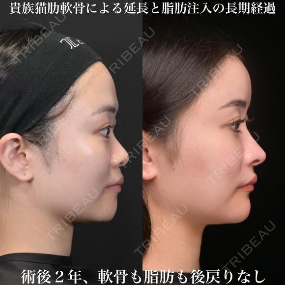 術後2年 北村医師とコラボオペ 貴族猫手術、肋軟骨による鼻中隔延長、耳介軟骨移植、鼻尖形成、ソフトプロテーゼ、小鼻縮小内外側 北村医師による額こめかみ、目の下、ゴルゴライン脂肪注入 アゴ:ヴォラックス注入 730日後 メイン用