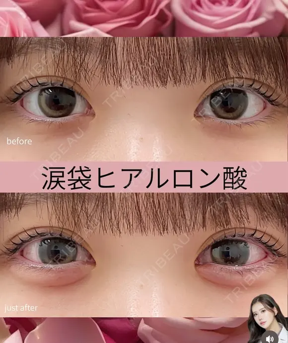 ヒアルロン酸（涙袋） before画像 メイン用