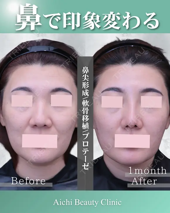 プロテーゼ、鼻尖形成、軟骨移植 after画像 メイン用