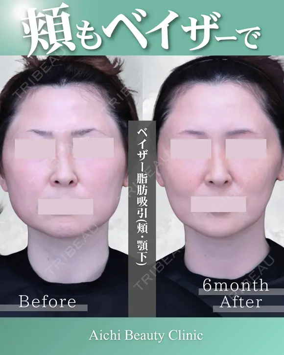 ベイザー脂肪吸引【頬・顎】 after画像 メイン用