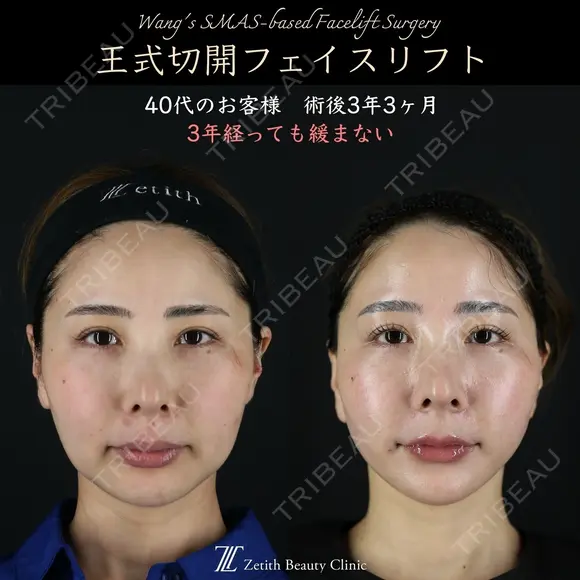 【王式切開リフト　術後3年3ヶ月】 1185日後 メイン用