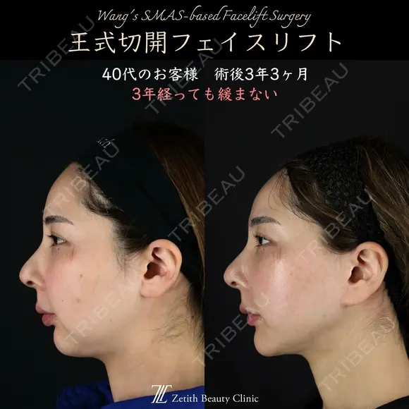 【王式切開リフト　術後3年3ヶ月】 1185日後 メイン用