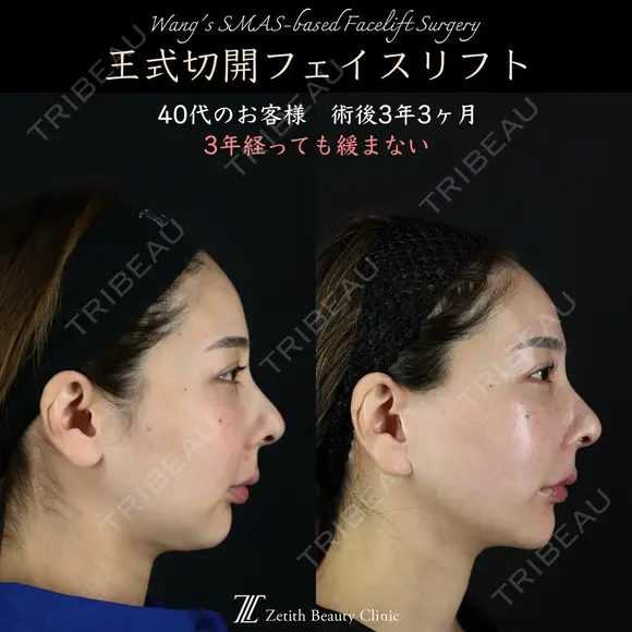 【王式切開リフト　術後3年3ヶ月】 1185日後 メイン用