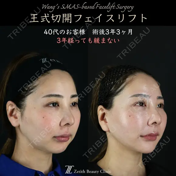 【王式切開リフト　術後3年3ヶ月】 1185日後 メイン用