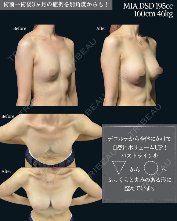 シリコンバック豊胸 90日後 メイン用