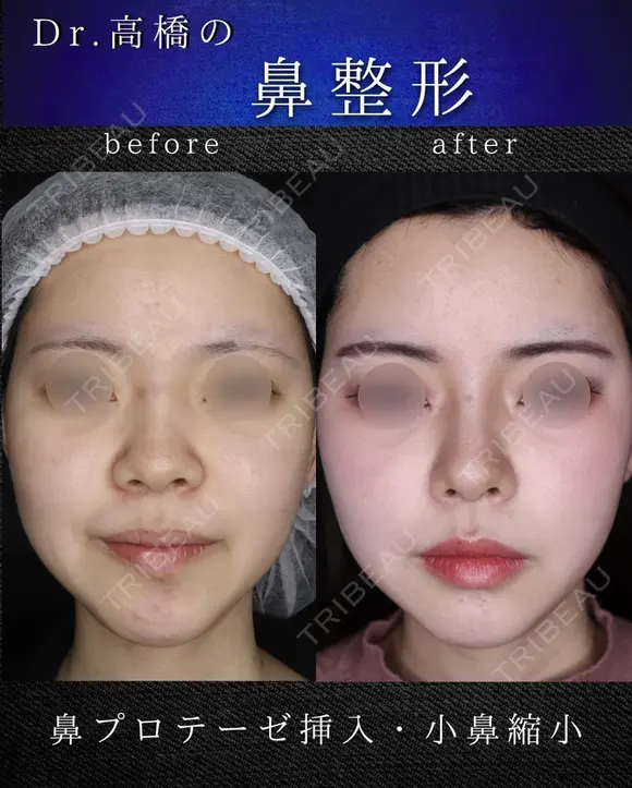 小鼻縮小(切開) before画像 メイン用