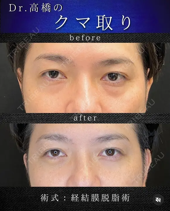 目の下のクマ取り(脱脂術) before画像 メイン用