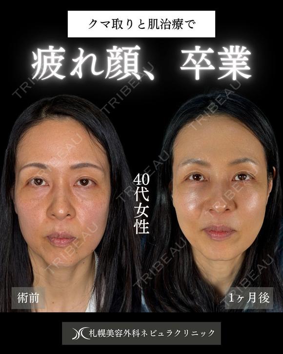 横田開DRによる🌟クマ取り×シミ取り🌟 before画像 メイン用