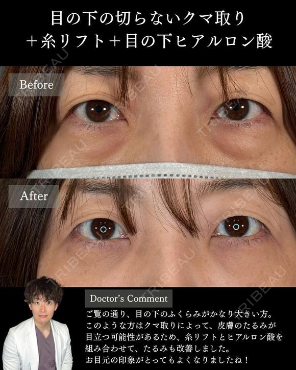 横田開DRによる🌟クマ取り×糸リフト×目の下のヒアルロン酸🌟 before画像 メイン用