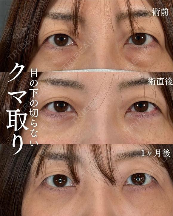 横田開DRによる🌟クマ取り×糸リフト×目の下のヒアルロン酸🌟 after画像 メイン用