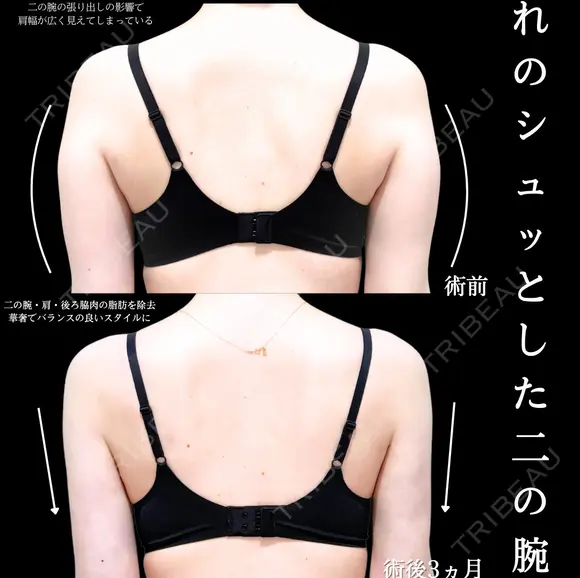 二の腕　肩　　脂肪吸引 before画像 メイン用