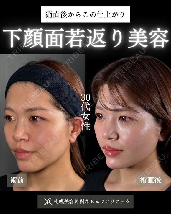 横田開DRによる🌟糸リフト×顎ヒアルで下顔面若返り🌟 after画像 メイン用