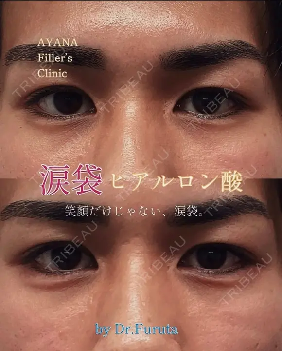 涙袋ヒアルロン酸 after画像 メイン用