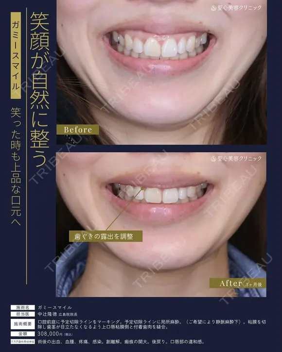 【40代女性・歯茎の露出を調整】ガミースマイル（3ヶ月後） 90日後 メイン用