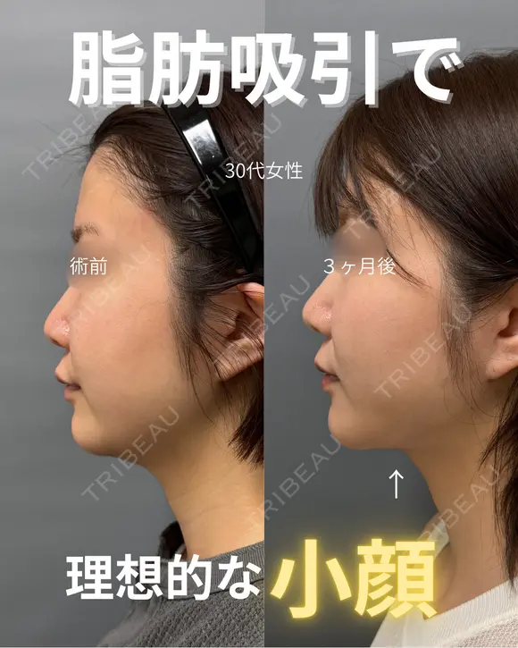 頬・顎下脂肪吸引 89日後 メイン用