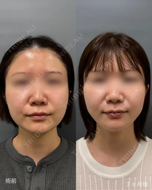 頬・顎下脂肪吸引 after画像 メイン用