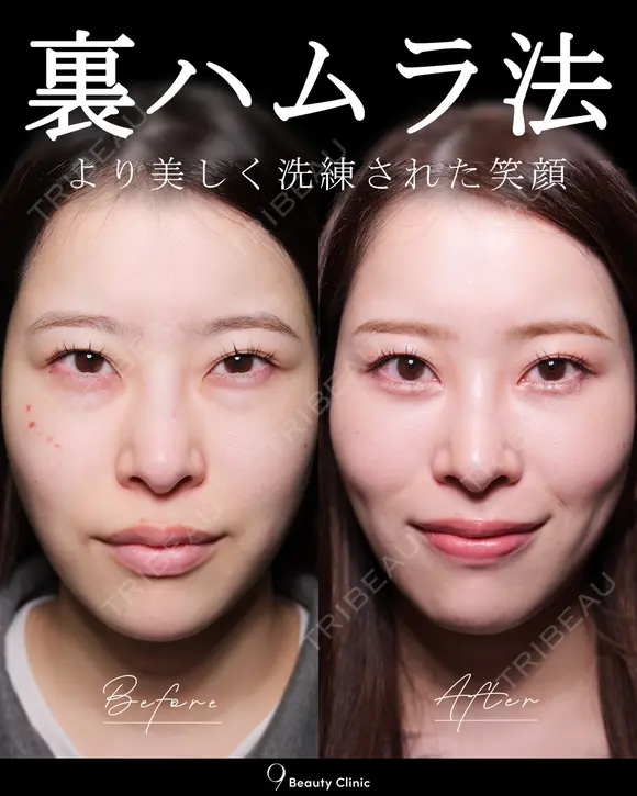 クマ治療　ハムラ法 after画像 メイン用