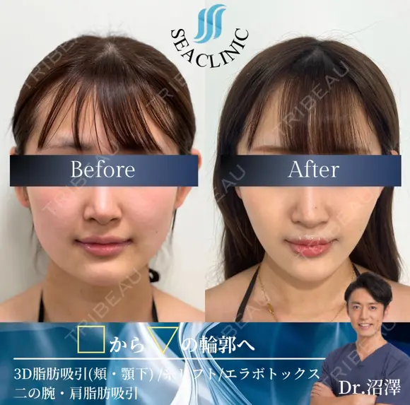 3D脂肪吸引（頬・顎下）/糸リフト/エラボトックス/二の腕・肩脂肪吸引 before画像 メイン用