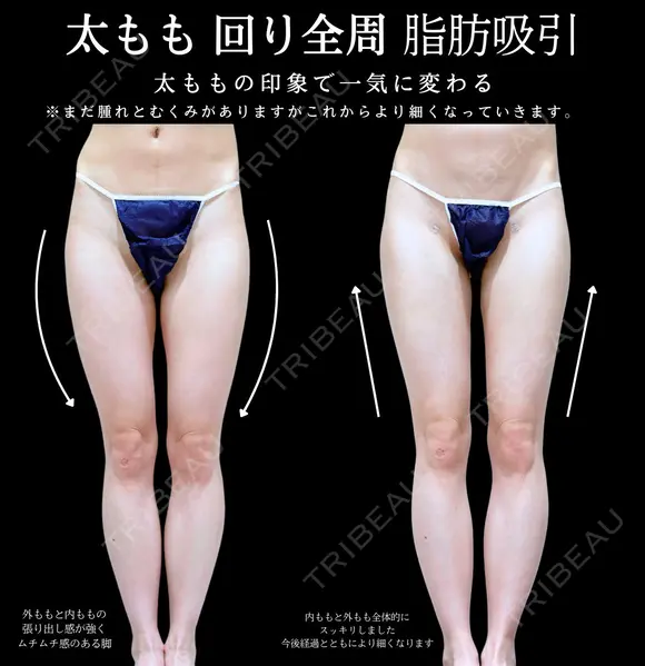 太もも　膝回り全周　脂肪吸引 before画像 メイン用