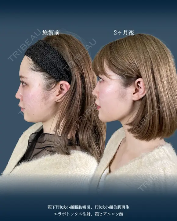 顔の脂肪吸引 60日後 メイン用