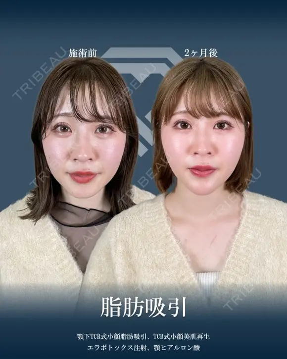 顔の脂肪吸引 before画像 メイン用