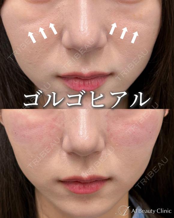ゴルゴヒアルロン酸 before画像 メイン用