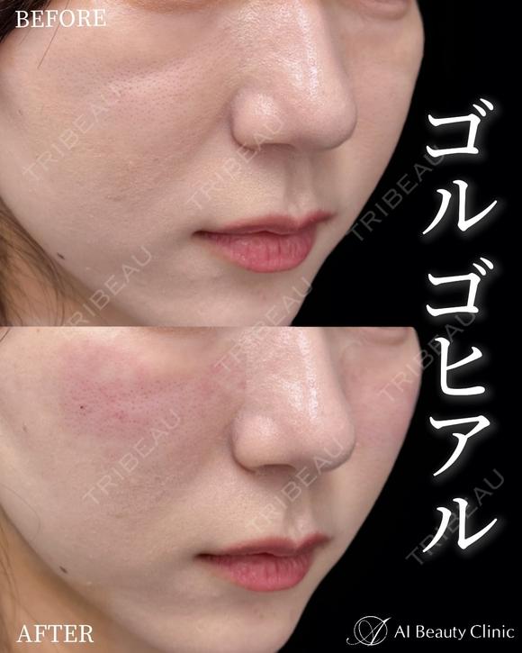 ゴルゴヒアルロン酸 after画像 メイン用
