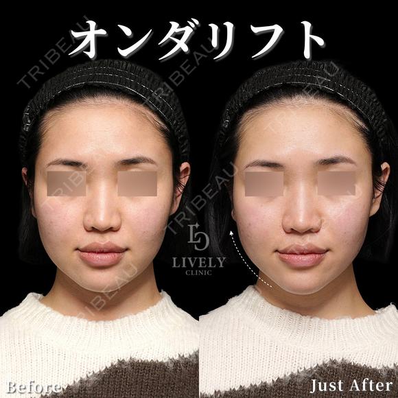オンダリフト before画像 メイン用