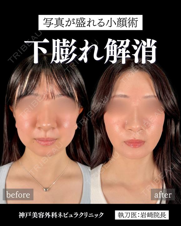 岩﨑先生による🔥小顔整形🔥 before画像 メイン用
