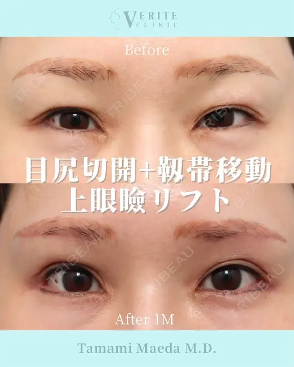 目尻切開＋靭帯移動＋上眼瞼リフト｜目力アップ✨ before画像 メイン用