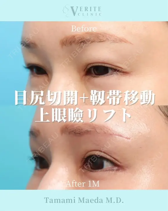 目尻切開＋靭帯移動＋上眼瞼リフト｜目力アップ✨ after画像 メイン用