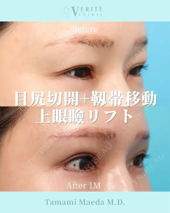 目尻切開＋靭帯移動＋上眼瞼リフト｜目力アップ✨ after画像 メイン用