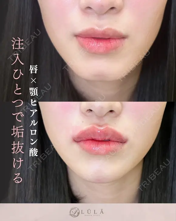 Ｃカールリップ（ボルベラ1cc）+顎（ボラックス1cc） before画像 メイン用