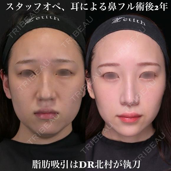 術後2年 耳による鼻中隔延長、耳介軟骨移植、鼻尖形成、猫手術、わし鼻切除、骨切り幅寄せ 720日後 メイン用