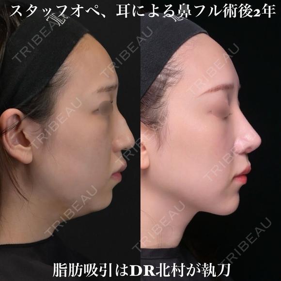 術後2年 耳による鼻中隔延長、耳介軟骨移植、鼻尖形成、猫手術、わし鼻切除、骨切り幅寄せ 72日後 メイン用
