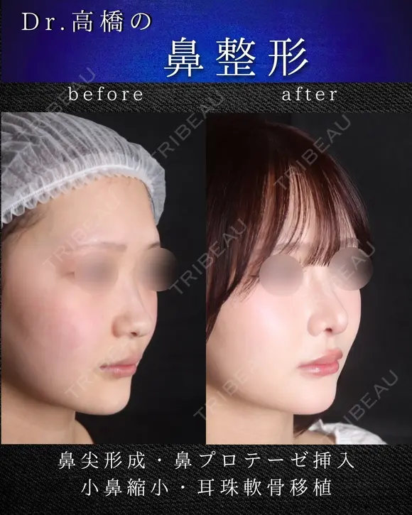 鼻尖形成・鼻プロテーゼ・小鼻縮小・耳珠軟骨移植 after画像 メイン用