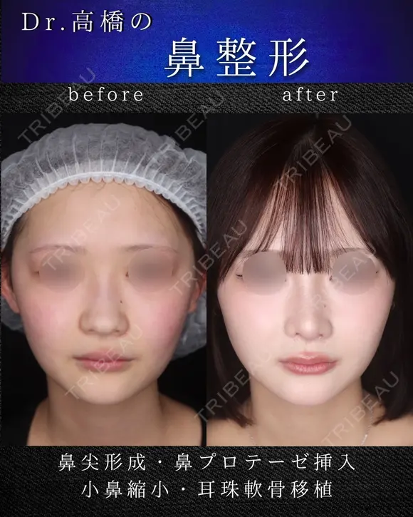 鼻尖形成・鼻プロテーゼ・小鼻縮小・耳珠軟骨移植 before画像 メイン用
