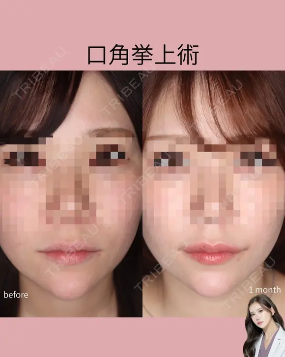 口角挙上術 before画像 メイン用